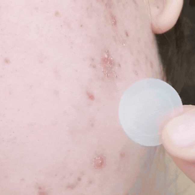 باتش ميكرونيدل للحبة المفاجئة